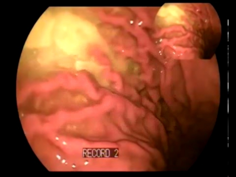 Гастроскопия с помощью видеоэндоскопической системы VME
